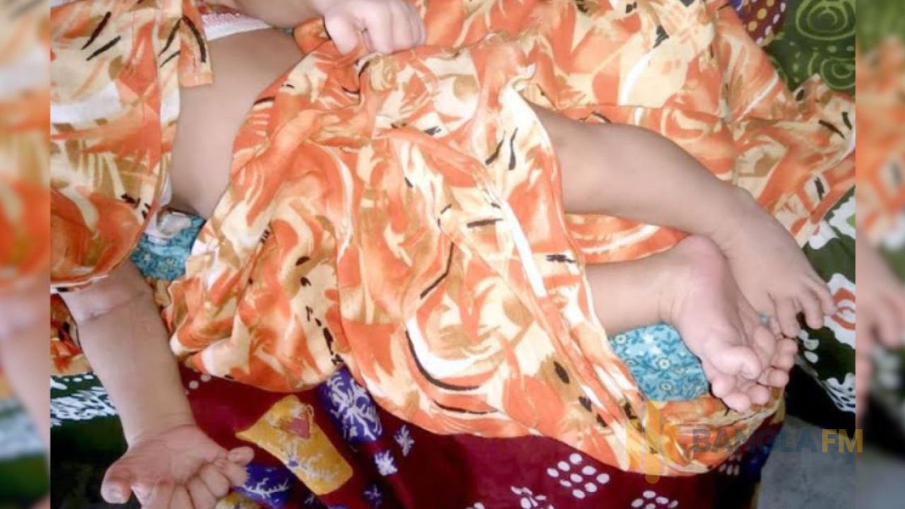 ফুলবাড়ীতে ২৮ আঙুল নিয়ে কন্যাশিশুর জন্ম