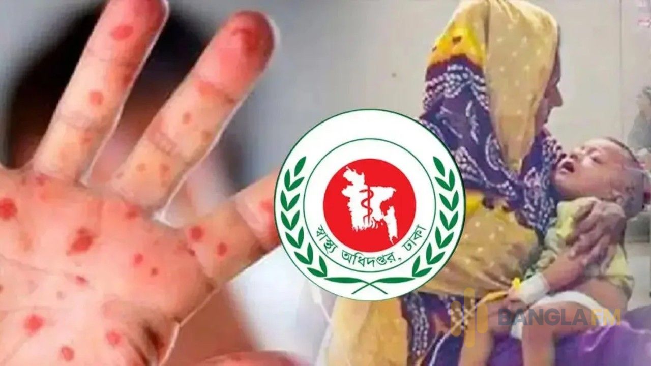 ২৪ ঘণ্টায় হাম উপসর্গে আরও ৪ শিশুর মৃত্যু