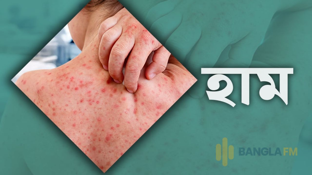 হামের উপসর্গ নিয়ে আরও ৭ মৃত্যু, মোট প্রাণহানি ১২১৪