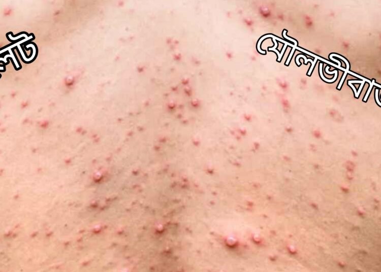 মৌলভীবাজারসহ সিলেটে হামের সংক্রমণ অব্যাহত